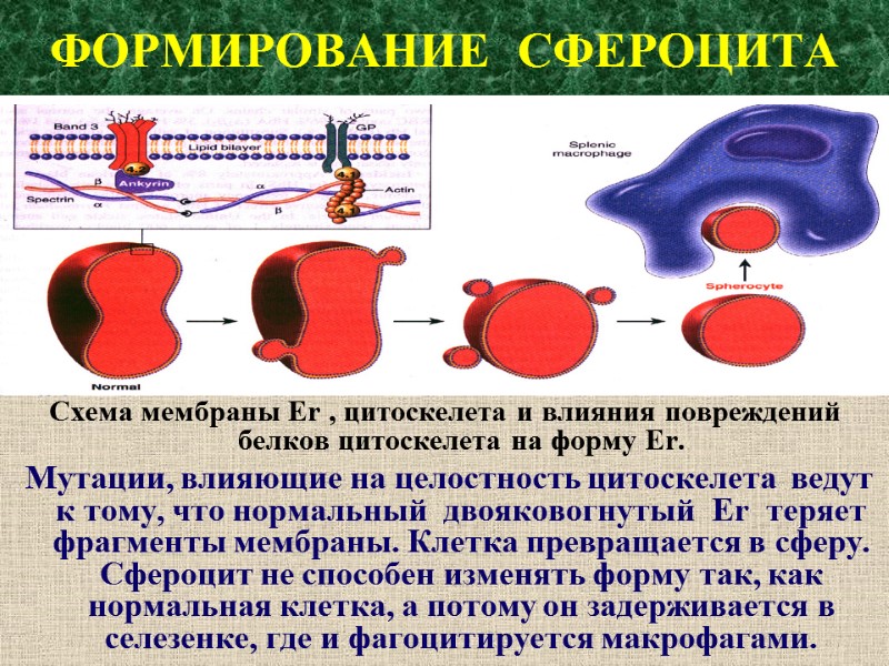 ФОРМИРОВАНИЕ  СФЕРОЦИТА Схема мембраны Er , цитоскелета и влияния повреждений белков цитоскелета на